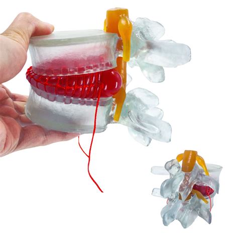 Veipho Human Anatomical Lumbar Disc Herniation Model Transparency ...