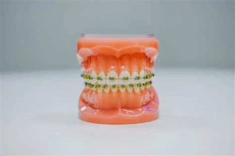 Night Guards To Protect Gums And Teeth