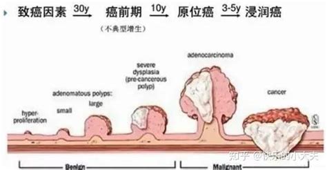 误把肠癌便血当痔疮，医生提醒：通过5点来分辨，早诊断早安心 - 知乎