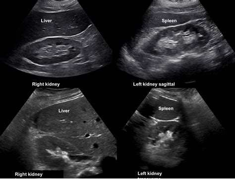What Is Renal Ultrasonography