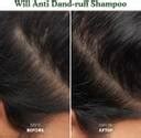 ORGANIC OASIS Will Anti Dandruff Shampoo Derma Approved Formula | For ...