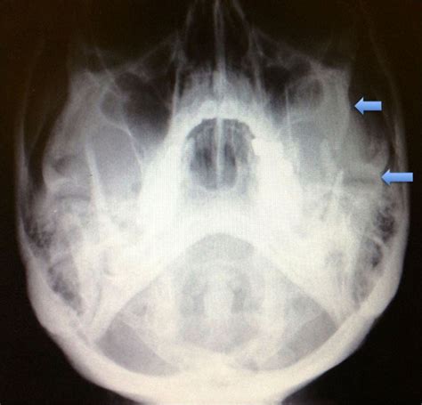 Zygomatic Arch Fracture X Ray View at Alicia Montes blog