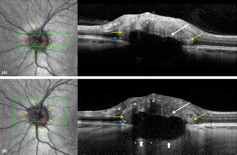 Optic Disc Drusen Eyewiki at Vaughn Gurule blog