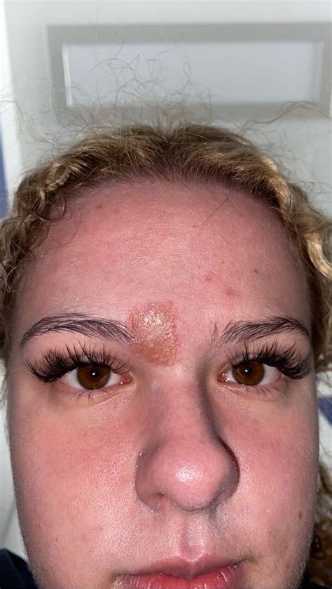 Image result for Blood Red Pimple