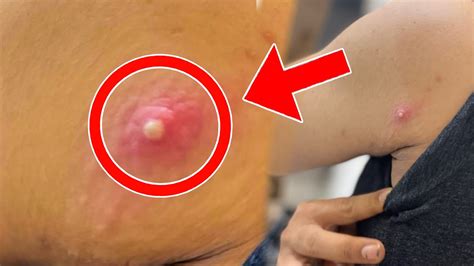 Image result for Exploding Pimple On Bottom