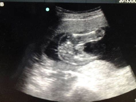孕22周女子遇上畸胎瘤，广东医生如何“带胎拆弹”？_女士_手术_进行
