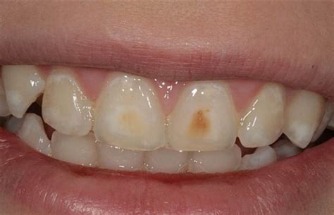 Image result for Tooth Stain