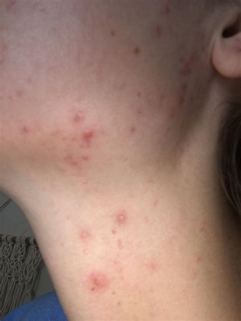 [Acne] Acne on neck (and jaw).... help!! : r/SkincareAddiction