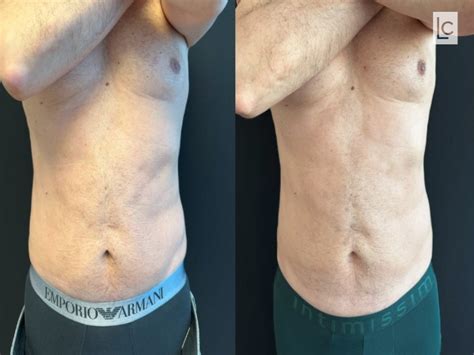 Coolsculpting no Abdómen Masculino: Antes e Depois