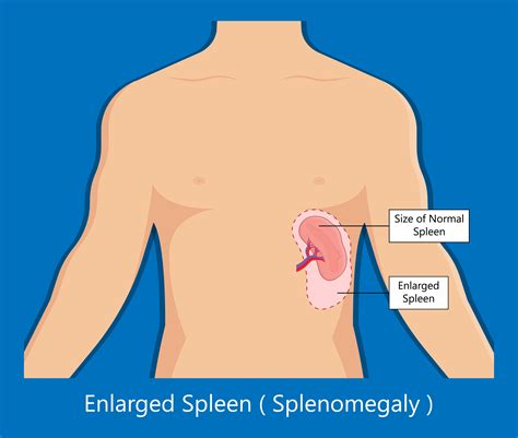10 Facts About Spleen Pain You Need to Know - Facty Health
