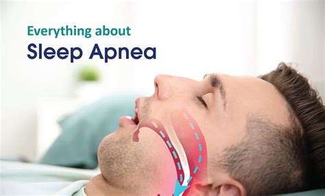 Image result for Sleep Apnea Example