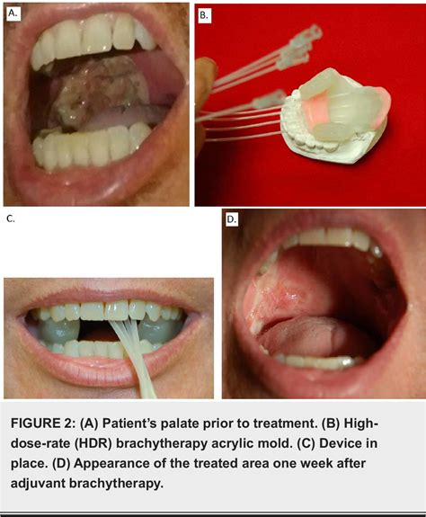 Figure 2 from Squamous Cell and Adenoid Cystic Carcinoma Collision ...