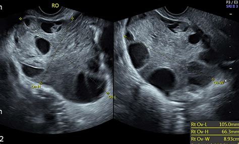 Synchronous bilateral ovarian torsion followed by recurrent unilateral torsion in a patient ...