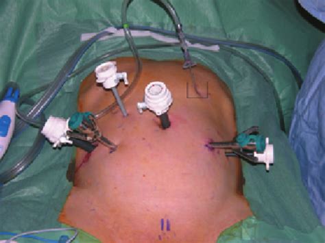 Robotic Prostate Surgery Procedure 的图像结果