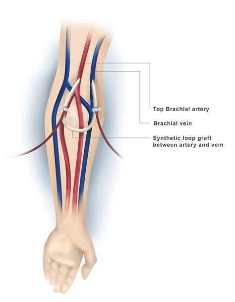 Dialysis Catheter Vs Av Fistula at Joseph Sauls blog