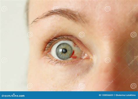 Eyelid With Blood Vessels Veins Royalty-Free Stock Photography | CartoonDealer.com #12722711
