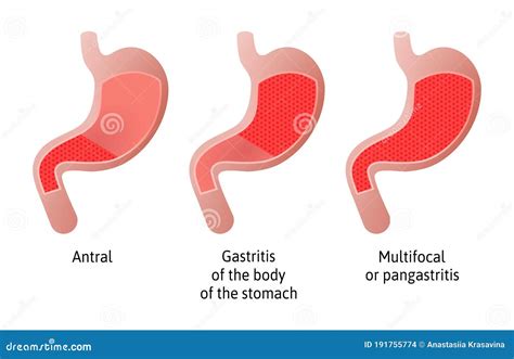 Localización De Gastritis Inflamación Del Revestimiento Del Estómago. Tres Tipos De Antral Del ...