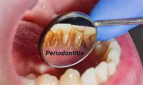 Study Finds Periodontitis Significantly Increases Glaucoma Risk