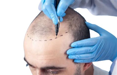 Robotic hair transplant – Tricoplast