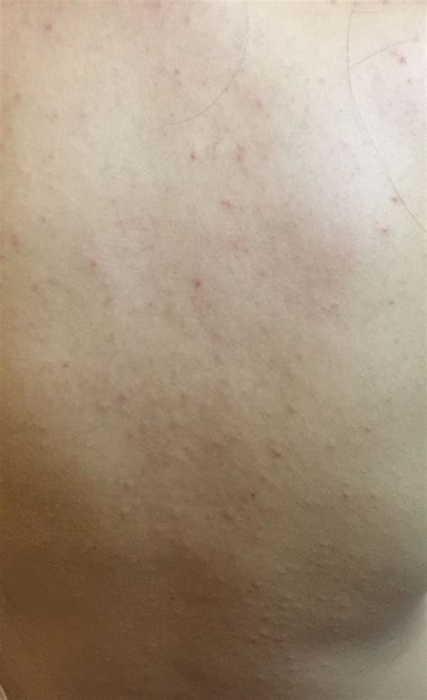 Ask a Dermatologist Online for Back Acne