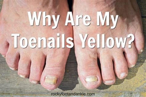why is my big toe nail yellow