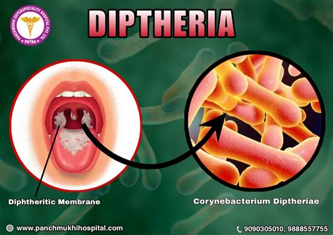 Diphtheria is a Common Pediatric Complication Treated Efficiently at Panchmukhi Hospital ... - caused by vs due to nghia