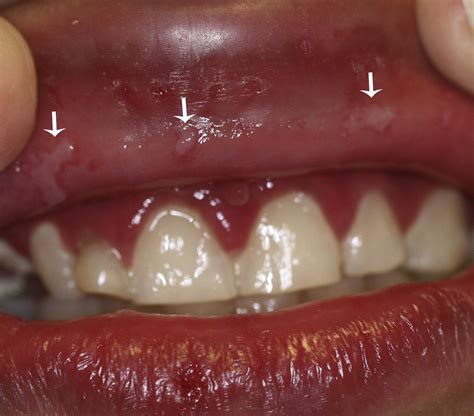 Mouth Herpes On Gums at Sara Sheridan blog