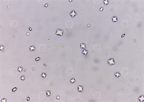 Calcium Oxalate Crystals In Urine