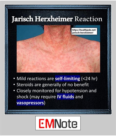 Treatment For Jarisch Herxheimer Reaction