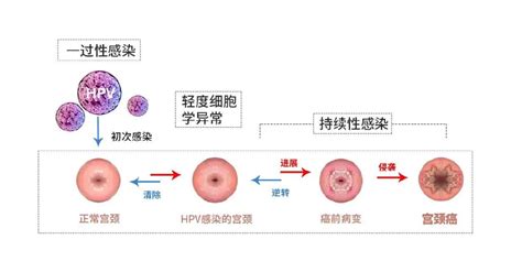 感染HPV，还能有性生活吗？ - 知乎