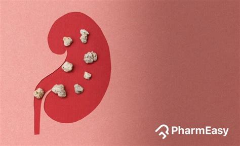 Kidney Stones: Symptoms, Causes, Home Remedies & More | PharmEasy