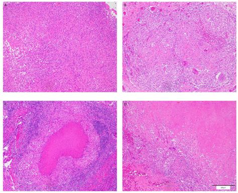 HIV-MTB Co-Infection Reduces CD4+ T Cells and Affects Granuloma Integrity