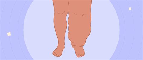 Elephantiasis: Symptoms, Causes, Signs & Safety Tips I Fluent Health