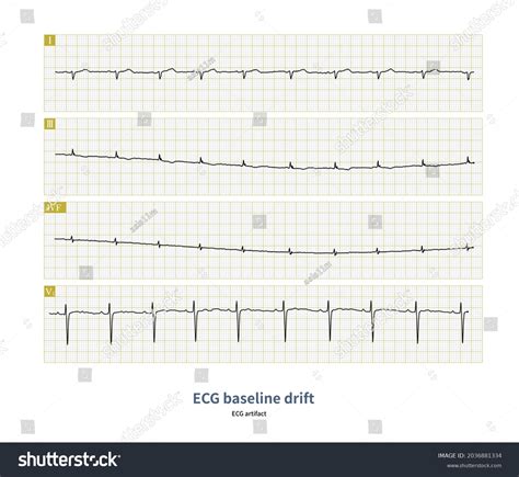 Ecg Baseline Drift Kind Ecg Artifact Stock Illustration 2036881334 ...