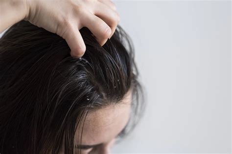 Dry scalp: causes and solutions - ANNVIO