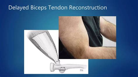 Distal Biceps Tendon Ruptures | Elbow Tendinopathies | South Windsor, Rocky Hill, Glastonbury CT ...