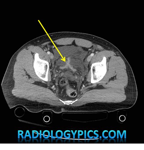 Image result for Exploding Bladder