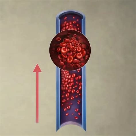 Deep Vein Thrombosis (DVT) Treatment in Mumbai | Endovascular Clinic