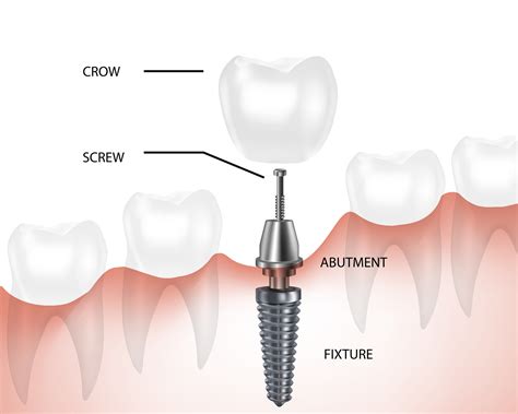 Dental Implant Components Ppt at Judith Poche blog