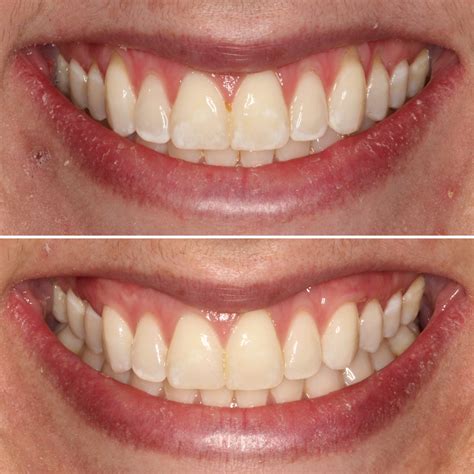 Esthetic Periodontics and Gum Grafting - Meridian Periodontics & Dental Implants
