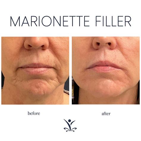Marionette Lines Juvederm at Jamie Gibb blog