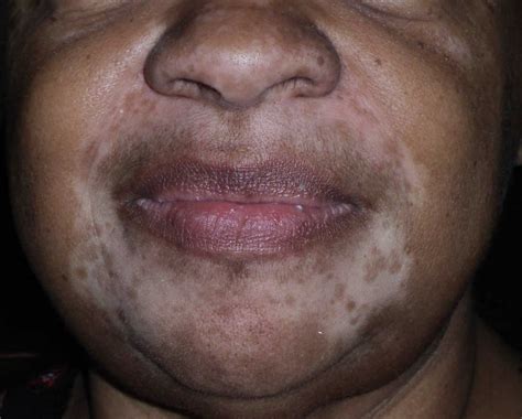 Leukoderma, definition, causes, symptoms, diagnosis, treatment & prognosis
