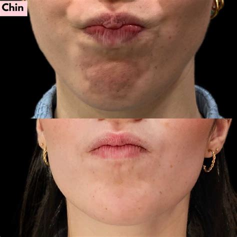 Image result for Chin Botox