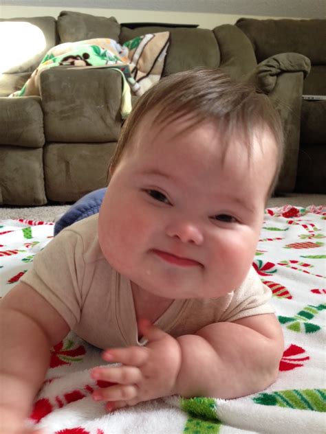 Infantile Spasm Video, A Prognosis, And What Symptoms Your Doctor Is Looking For.