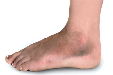 Broken ankle - NHS.UK