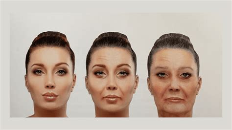 Profhilo Structura Stockholm | Moisturize & Rejuvenate Skin