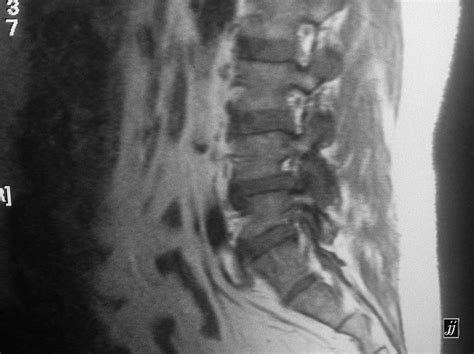 Facet Joint Effusion Causes at Sheila Tejada blog