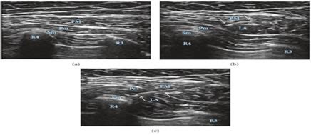 Figure 3: US image showing drug distribution between the muscle layers