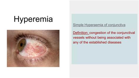 Symptomatic conditions of conjunctiva | PPT