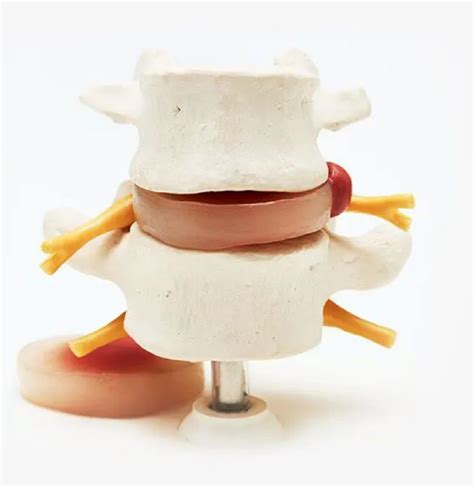 Image result for Disc Replacement Procedure